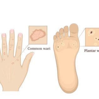 warts-on-the-hand-and-foot